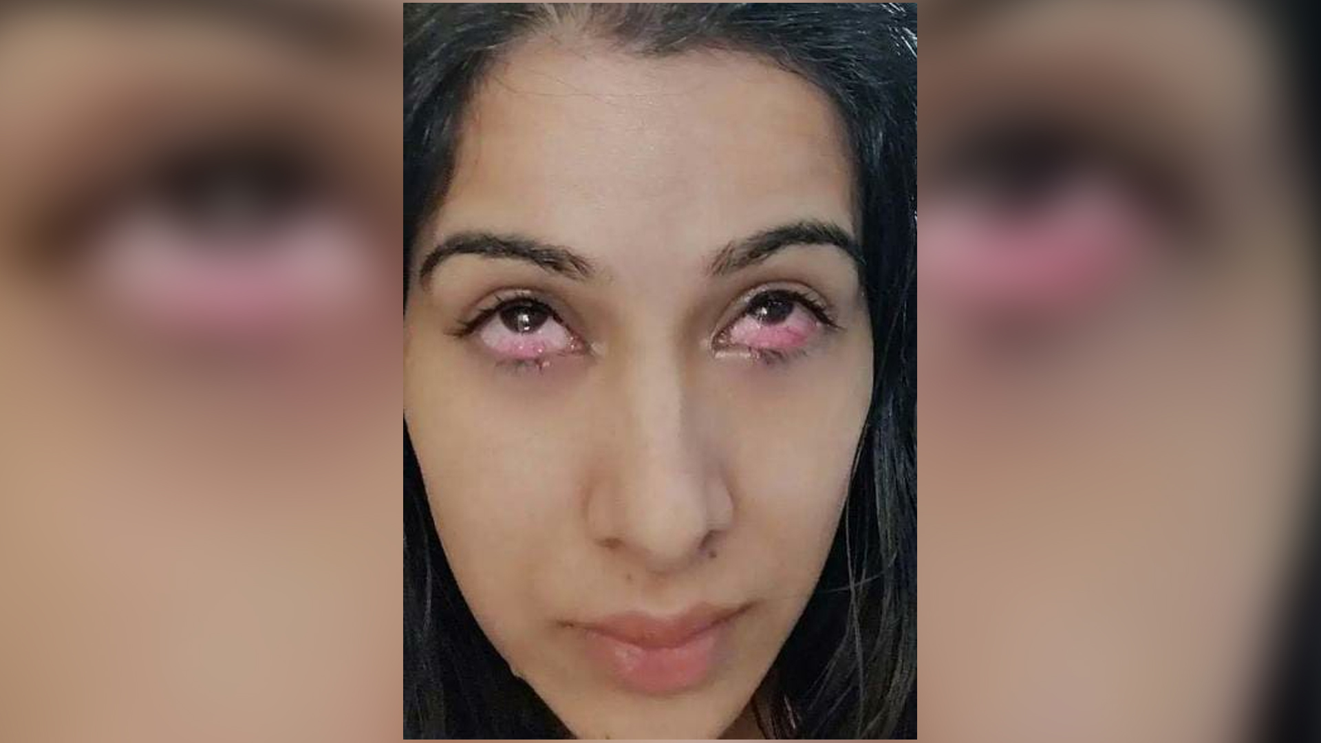 Bigg Boss 14: Pics Of Sara Gurpal’s Injured Eyes; Actress Hurt By Nikki Tamboli’s Acrylic Nails