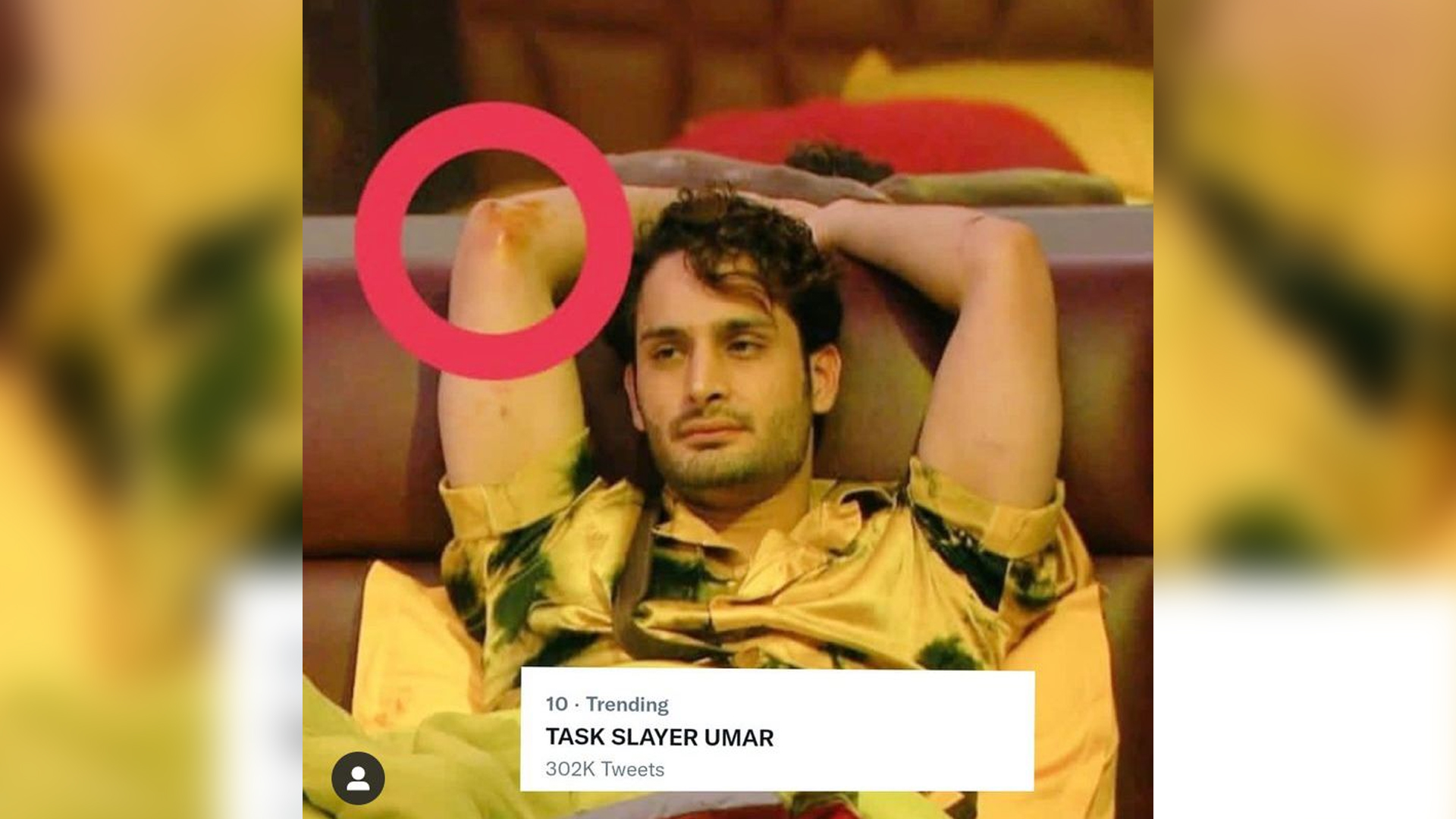 Umar Riaz bruised during a task, picture goes viral on the internet. Fans trend Task Slayer Umar*