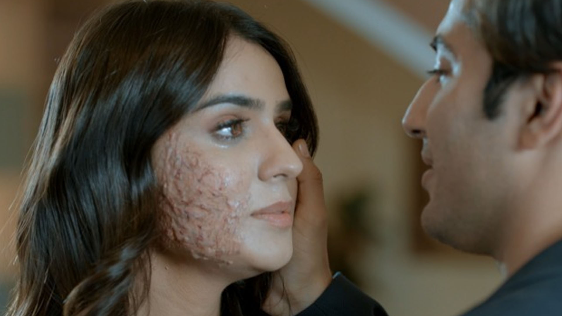 Check-Out Sidhika Sharma’s Portrayal In A Cute Love Story Of An Acid Victim Which Will Melt Your Heart